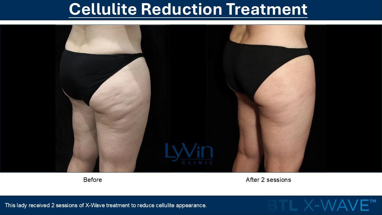 X-Wave Before and After - First